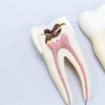 Teeth Roots Exposed : What Does it Mean?