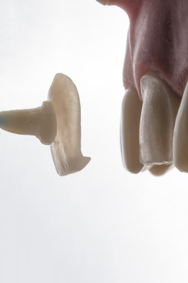 photo of a veneers shell being attached to the teeth