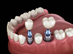 an accurate illustration of dental implants