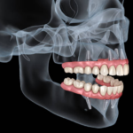 Who Does Dental Implants?