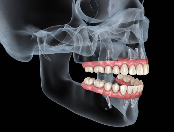 3D illustration of human teeth with several dental implants