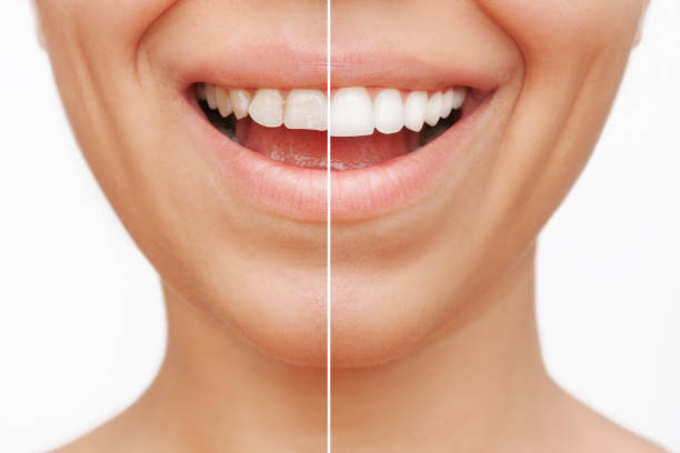 a before and after comparison of teeth after a dental procedure