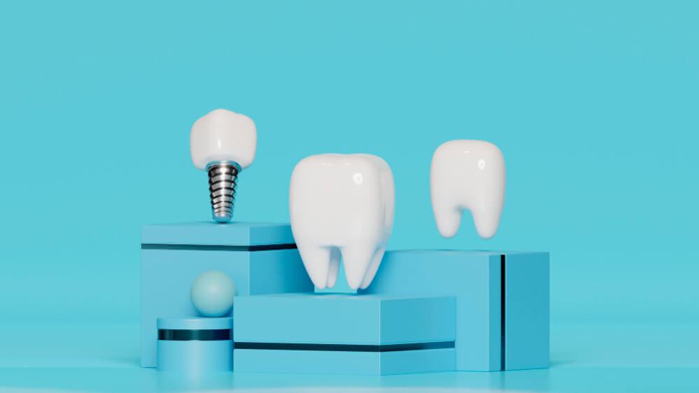 image of dental implant and natural teeth