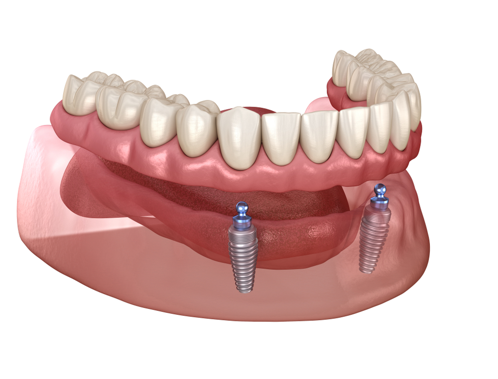 Example of an all on 4 implant supported denture