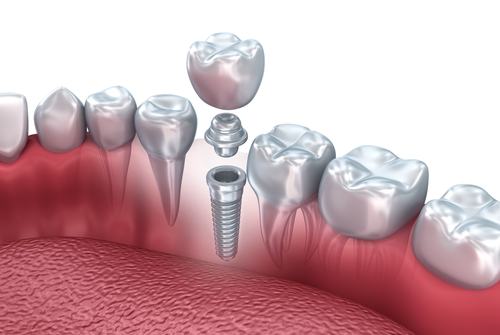 Example of a single-tooth implant