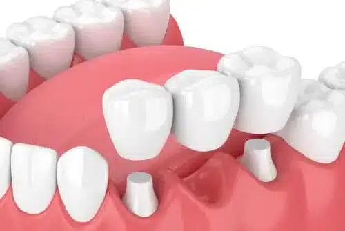 dentalbridge e1759848107585