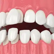 veneers 2 (1)