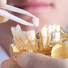 missing teeth 4.webp